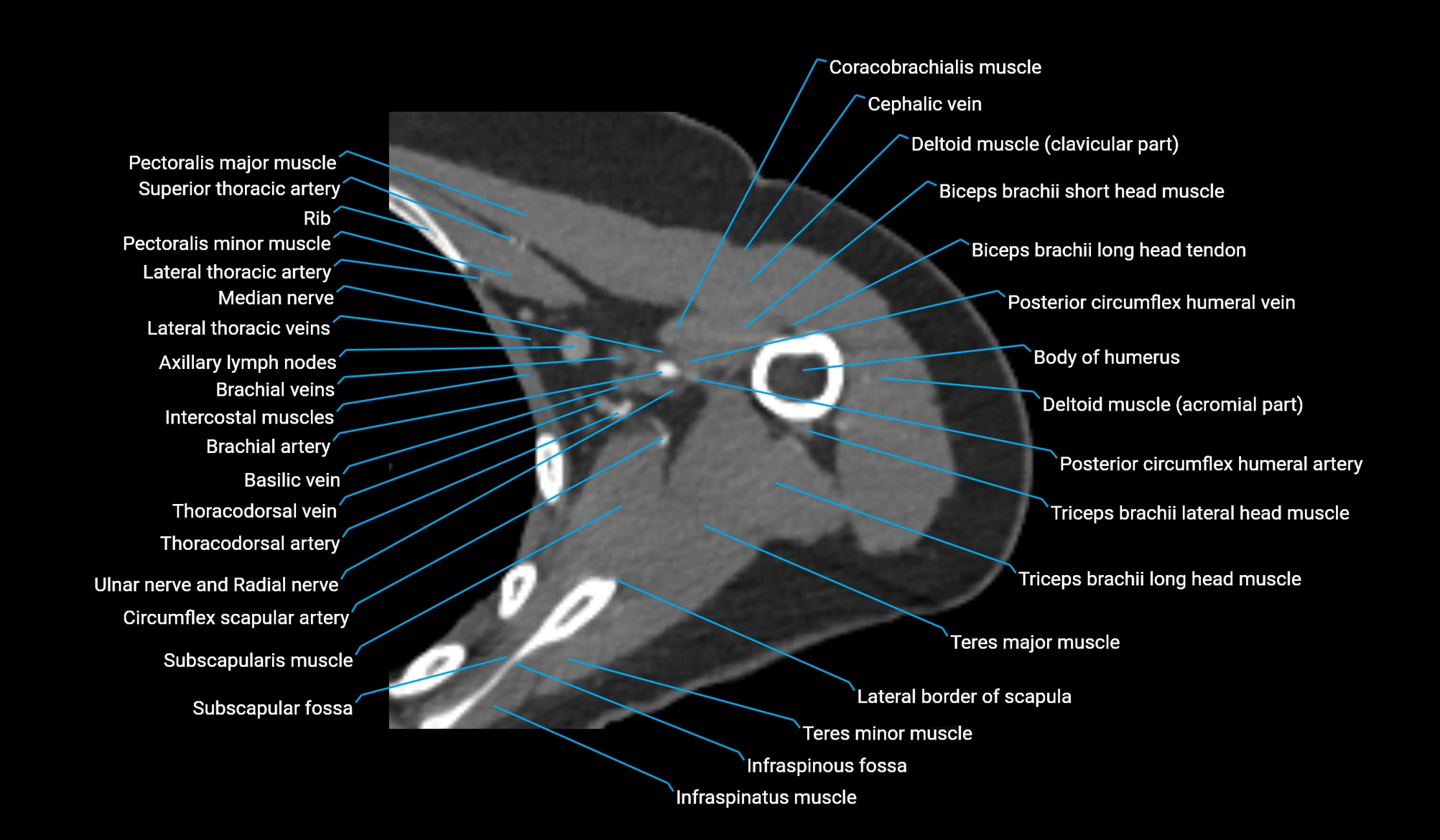 CT upper arm axial  cross sectional anatomy labelled radiology image -00136.webp